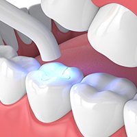 07 Close-up of molar pain-free cavity filling treatment with white composite dental filling in Cheras dental clinic