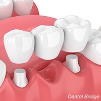 zirconia dental bridge Dentist fitting a dental bridge to replace missing teeth at Putramahkota Dental Clinic in Bandar Mahkota Cheras