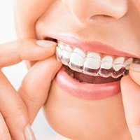 memory shaped clear aligner Patient wearing clear aligners for invisible teeth straightening at Putramahkota Dental Clinic