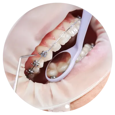 1711676126sec3-pic3 Close-up of traditional or self-ligating metal braces on teeth for orthodontic treatment in Cheras