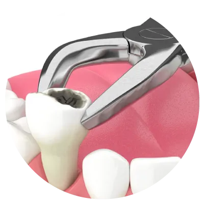 1712114523sec3-pic10 Painless Tooth extraction procedure performed by dentist at klinik pergigian putramahkota in Bandar Mahkota Cheras
