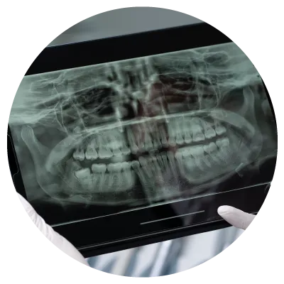 1712114595sec3-pic11 Dental X-ray showing full set of teeth for oral health assessment and to detect tooth decay and cavities