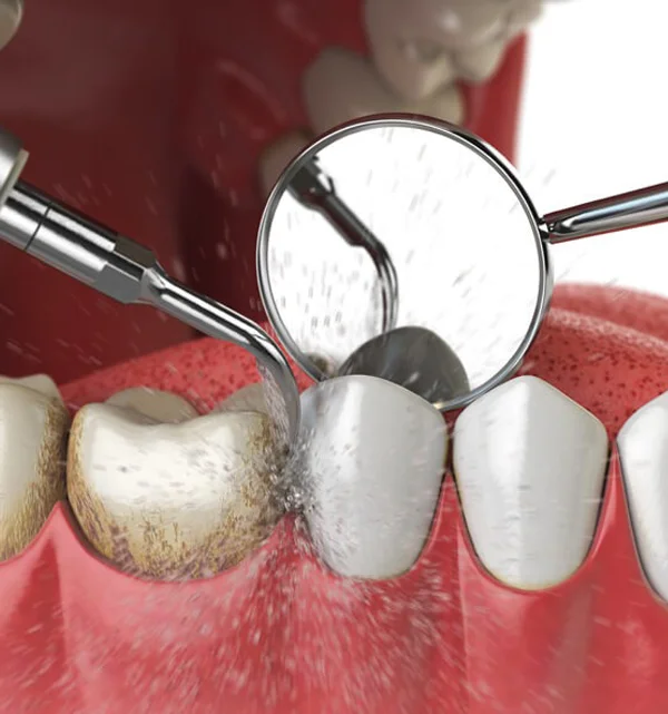 Scaling-and-Polishing Close-up of dental scaler removing plaque and tartar during teeth cleaning