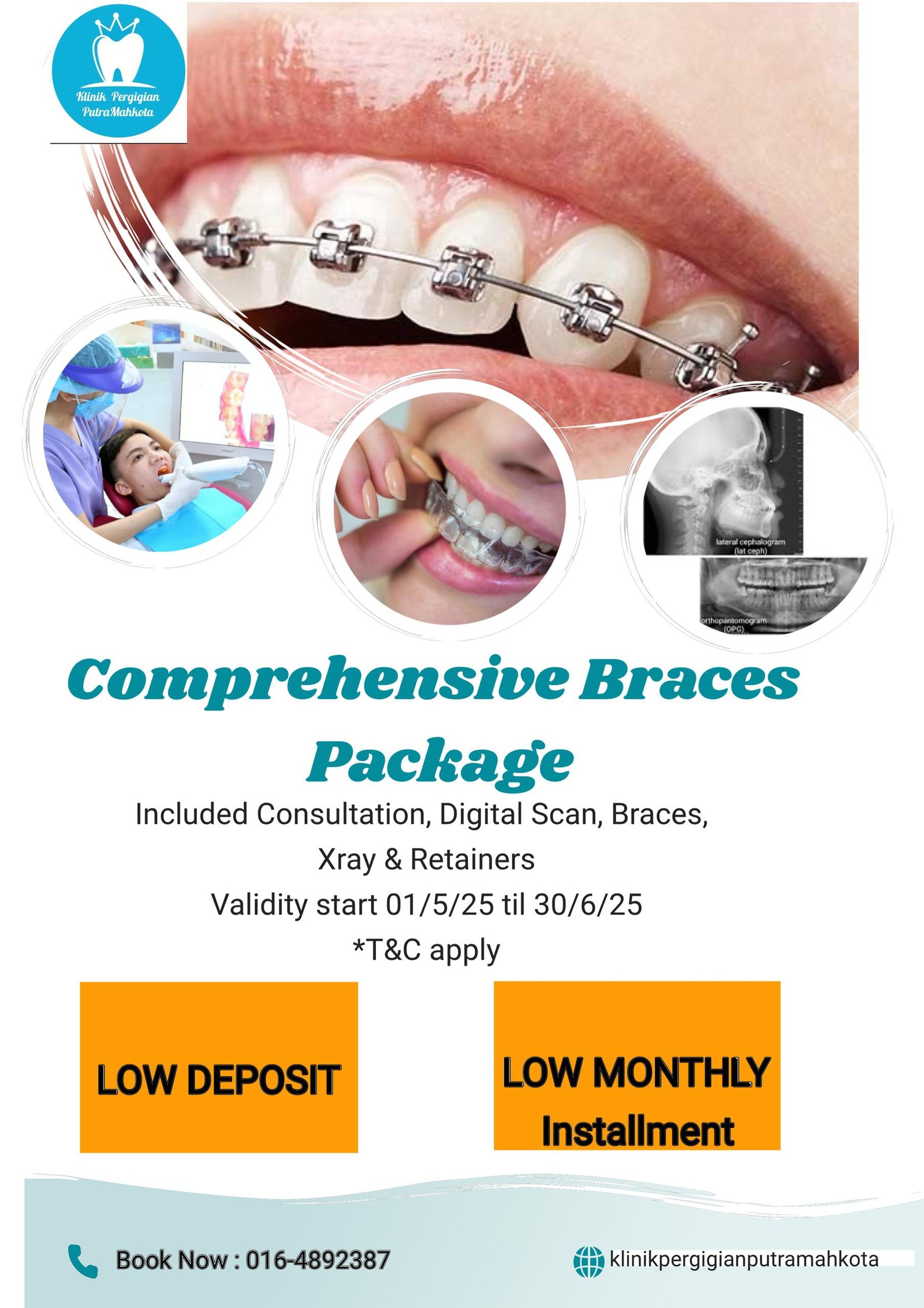 affordable braces package with low deposit, low monthly instalment at Putramahkota Dental Clinic in Bandar Mahkota Cheras.