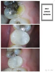Filling restoration is one way to repair broken or decayed tooth back to its function and esthetic