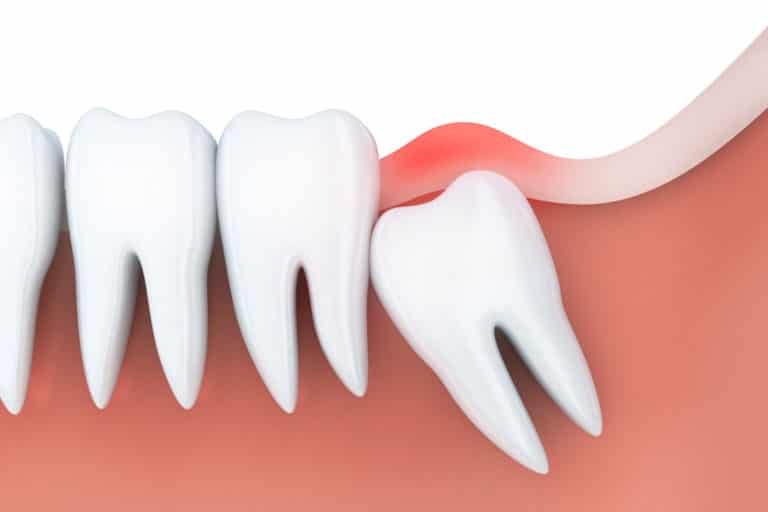 wisdom-teeth-removal-and-recovery-768x512 impacted wisdom tooth causing gum inflammation, requiring removal