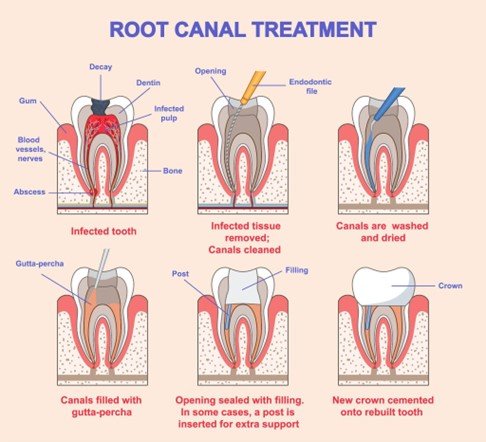 A-Step-by-Step-Guide-to-Root-Canal-Treatment Root canal treatment diagram at Putramahkota Dental Clinic Mahkota Cheras