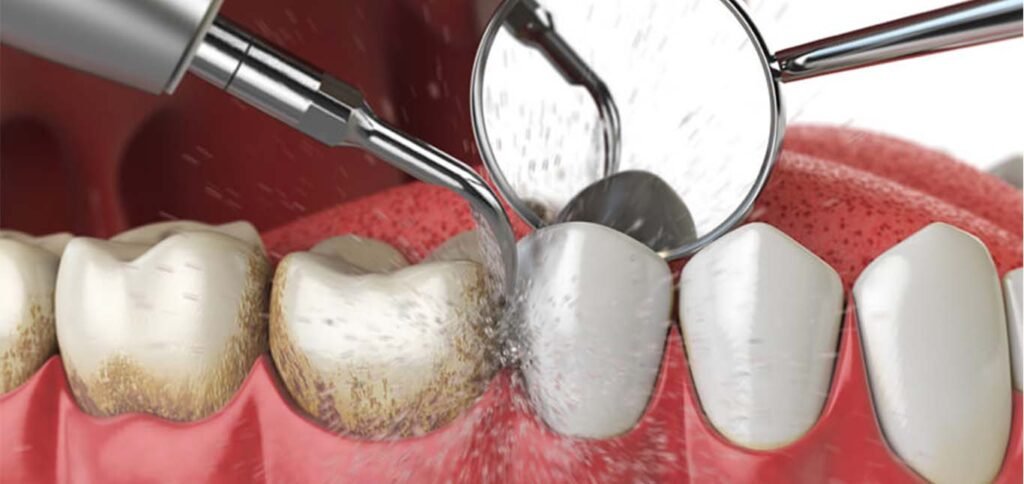 Dental-Scaling-Polishing Professional scaling and polishing at Putramahkota Dental Clinic in Mahkota Cheras