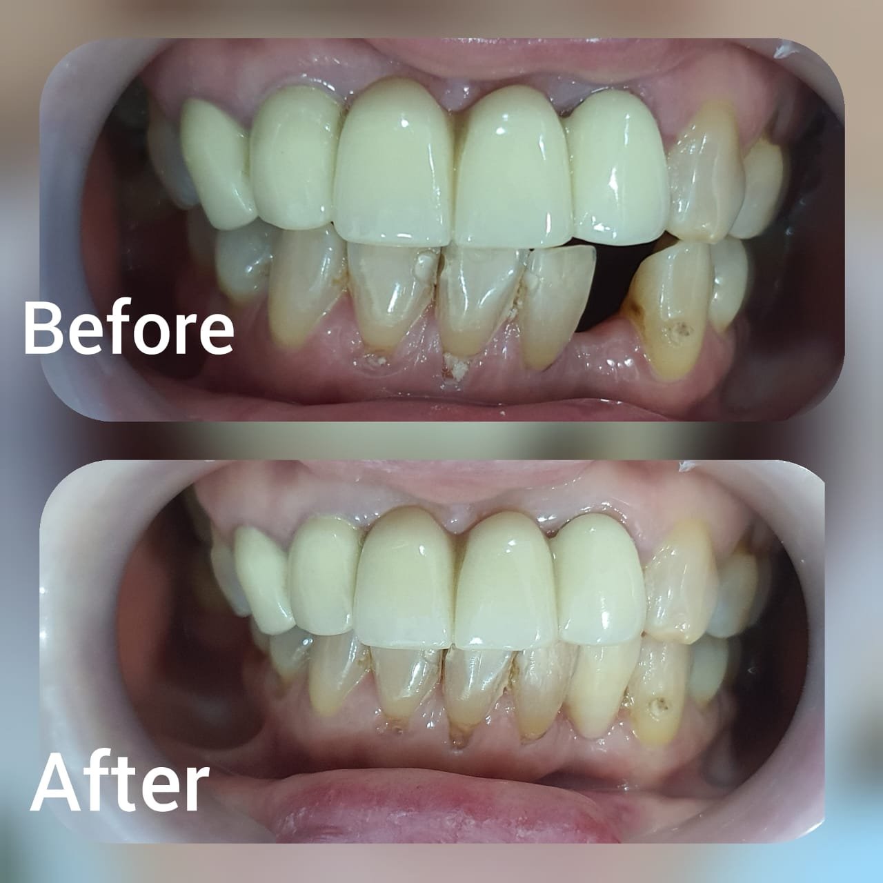 Advanced FRC fiber reinforced composite treatment at Putramahkota Dental Clinic providing durable tooth restoration in Mahkota Cheras