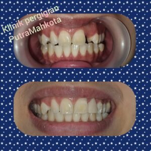 Fiber reinforced composite FRC dental restoration at Putramahkota Clinic strengthening and restoring tooth structure in Mahkota Cheras