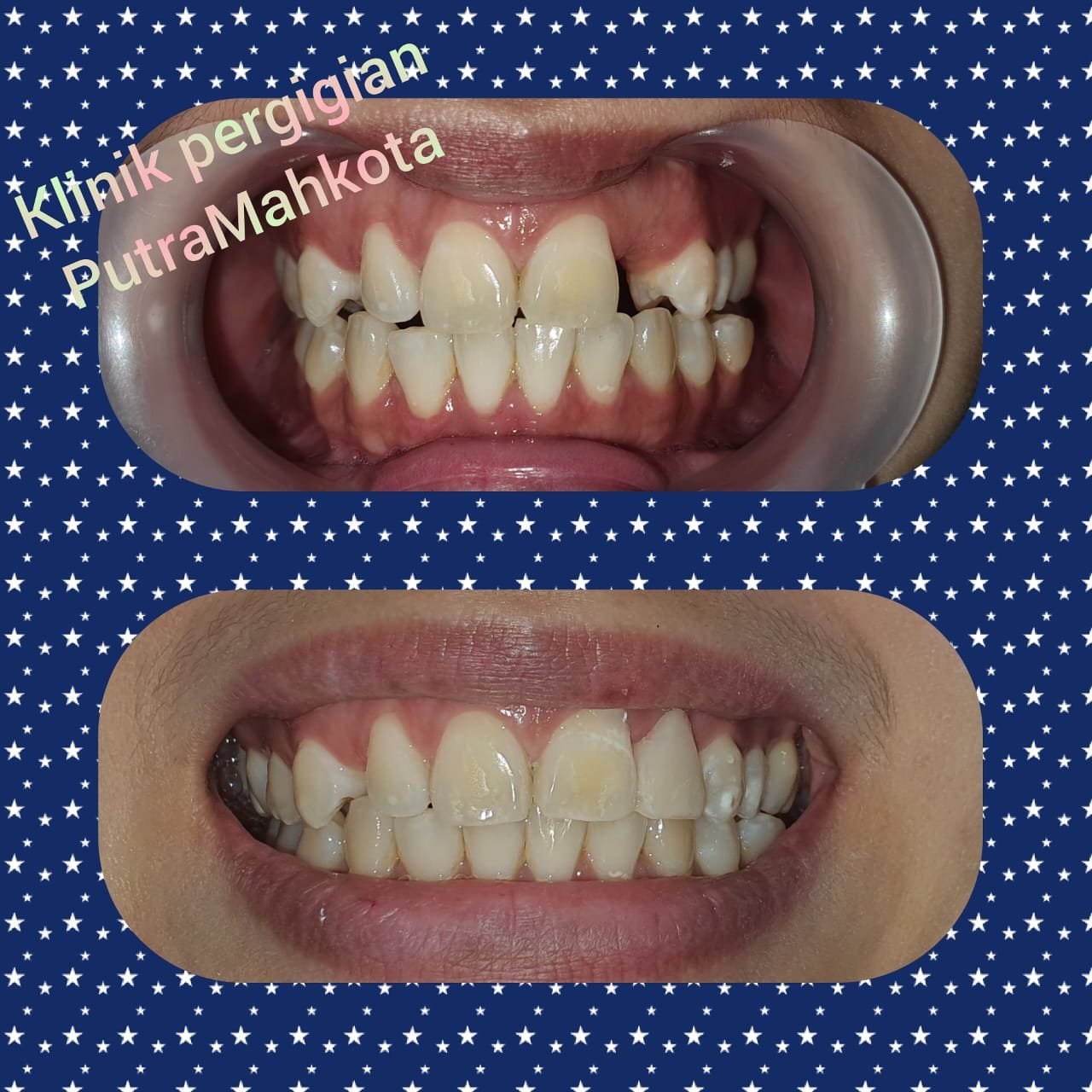 Fiber reinforced composite FRC dental restoration at Putramahkota Clinic strengthening and restoring tooth structure in Mahkota Cheras