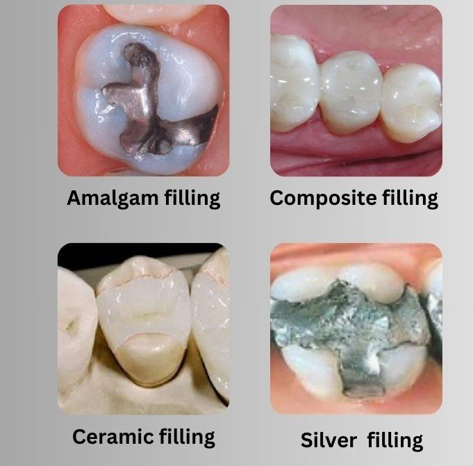 Types of Teeth Restoration / Teeth Filling Material - 1 Different types of dental fillings at Putramahkota Dental Clinic in Mahkota Cheras