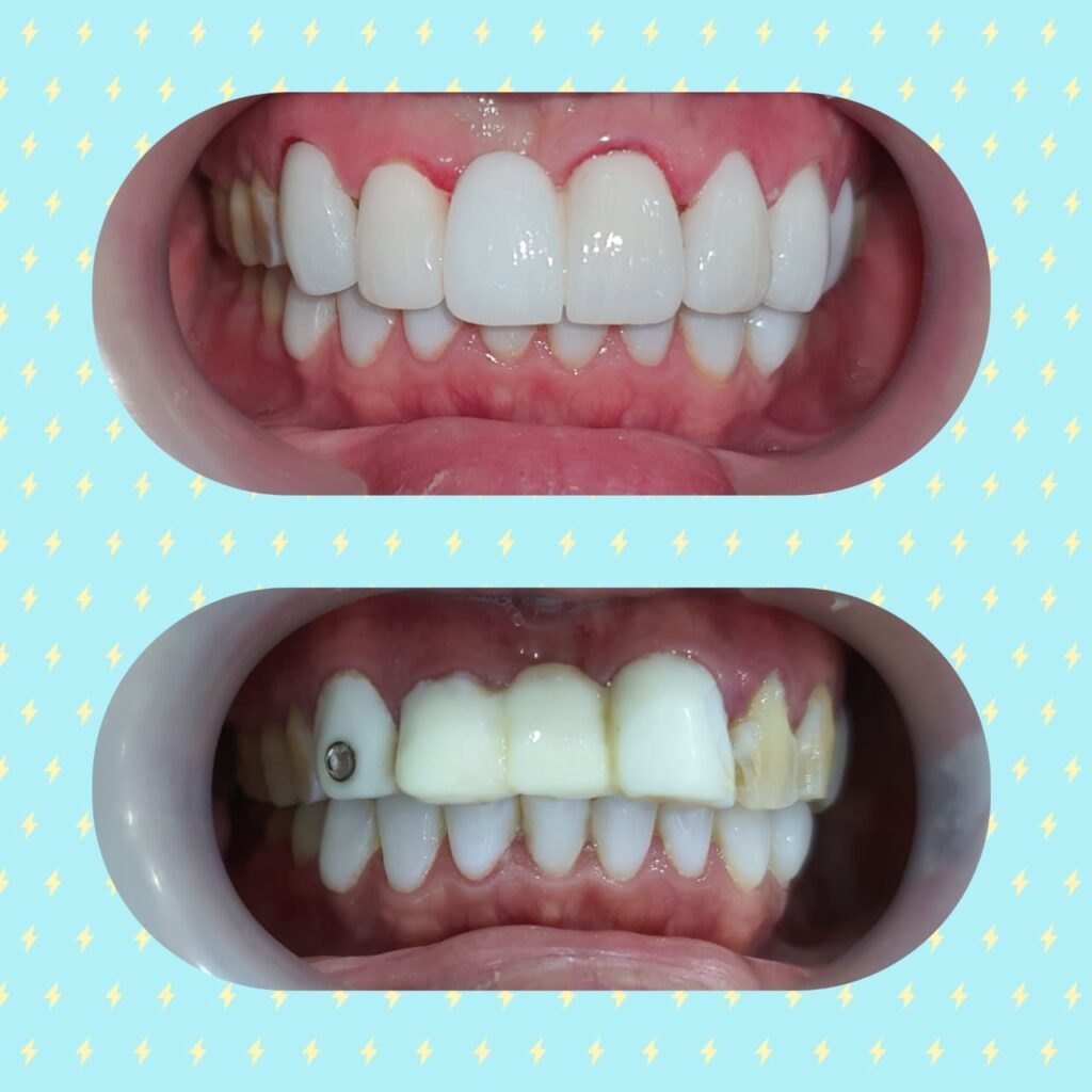 Beautiful smile with dental bridge at Putramahkota Dental Clinic Mahkota Cheras