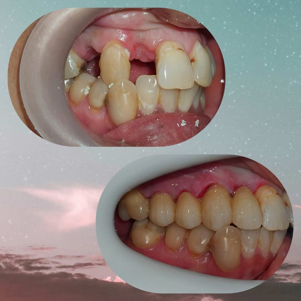 Before and after dental bridge treatment results
