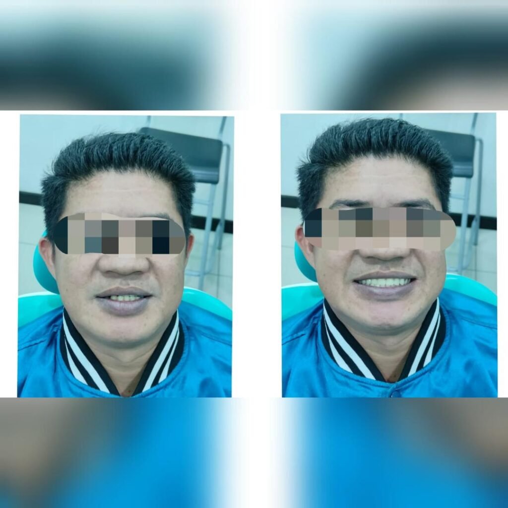 WhatsApp Image 2026-03-18 at 8.52.50 AM Before and after denture treatment at Putramahkota Dental Clinic showing successful smile restoration in Mahkota Cheras