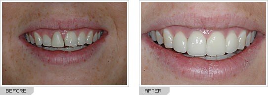 ba_porcelain_crowns Beautiful smile with dental crown at Putramahkota Dental Clinic Mahkota Cheras