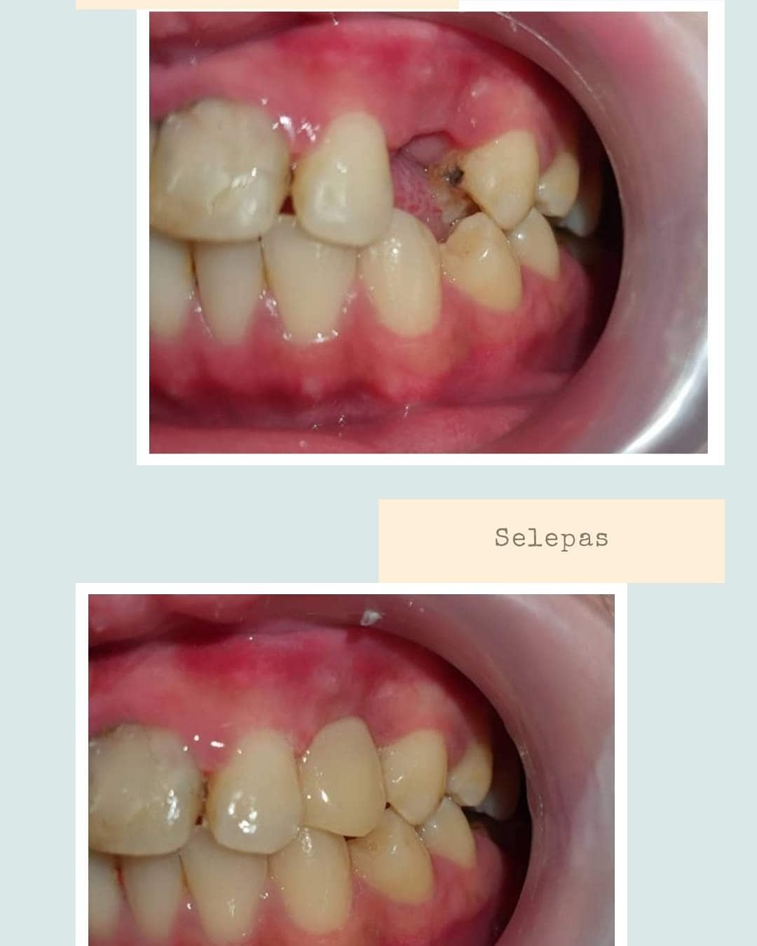 Before and after FRC replacement showing restored tooth strength and durability at Putramahkota Dental Clinic in Mahkota Cheras