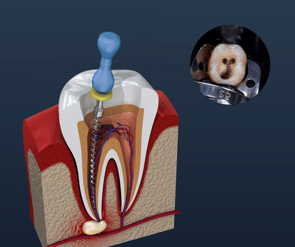 blue-annd-white-modern-Medical-Youtube-Thumbnail Endodontist performing root canal procedure at Putramahkota Clinic