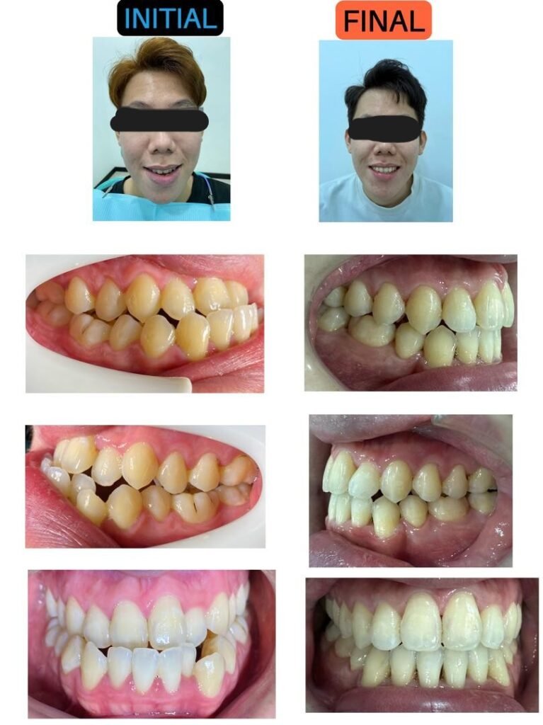 Before and after braces treatment at Putramahkota Dental Clinic Mahkota Cheras