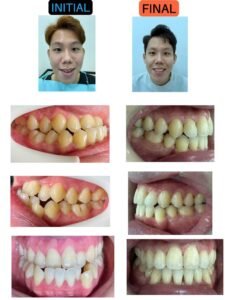 Before and after braces treatment at Putramahkota Dental Clinic showing straightened teeth alignment in Mahkota Cheras