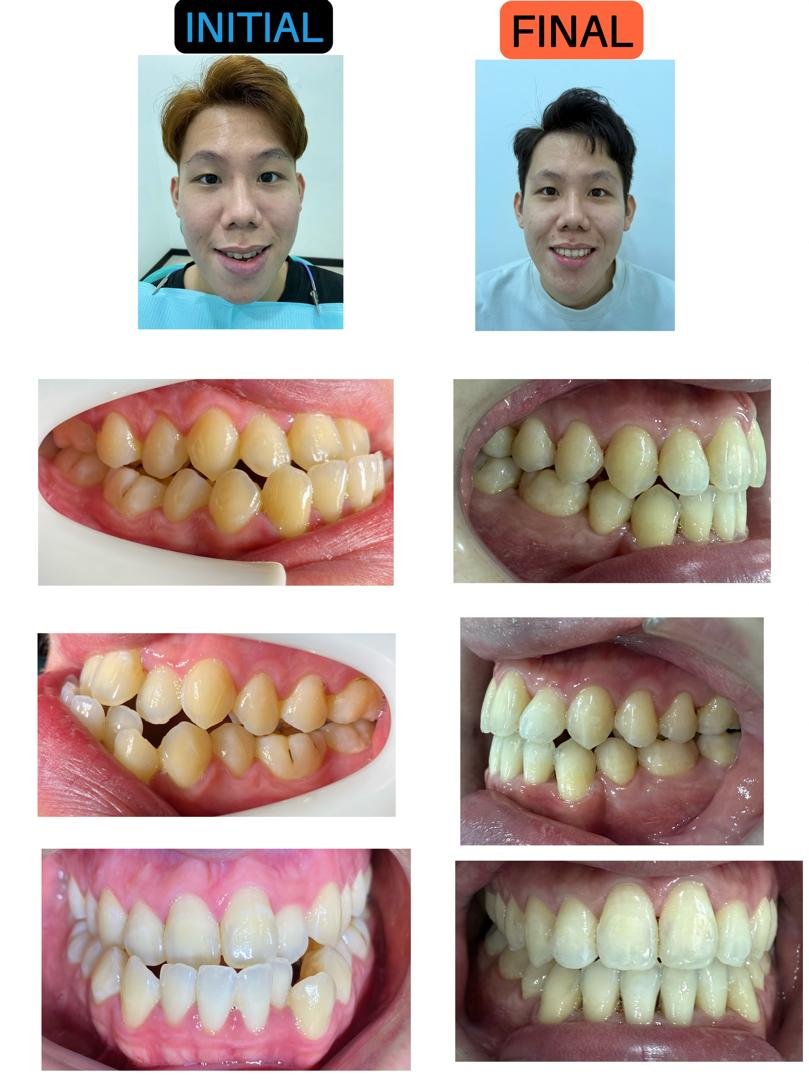 Before and after braces treatment at Putramahkota Dental Clinic showing straightened teeth alignment in Mahkota Cheras
