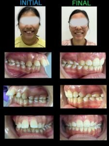 Braces treatment results showing teeth straightening and improved smile at Putramahkota Dental Clinic in Mahkota Cheras