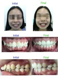 Braces orthodontic treatment showing teeth alignment and bite correction at Putramahkota Dental Clinic in Mahkota Cheras