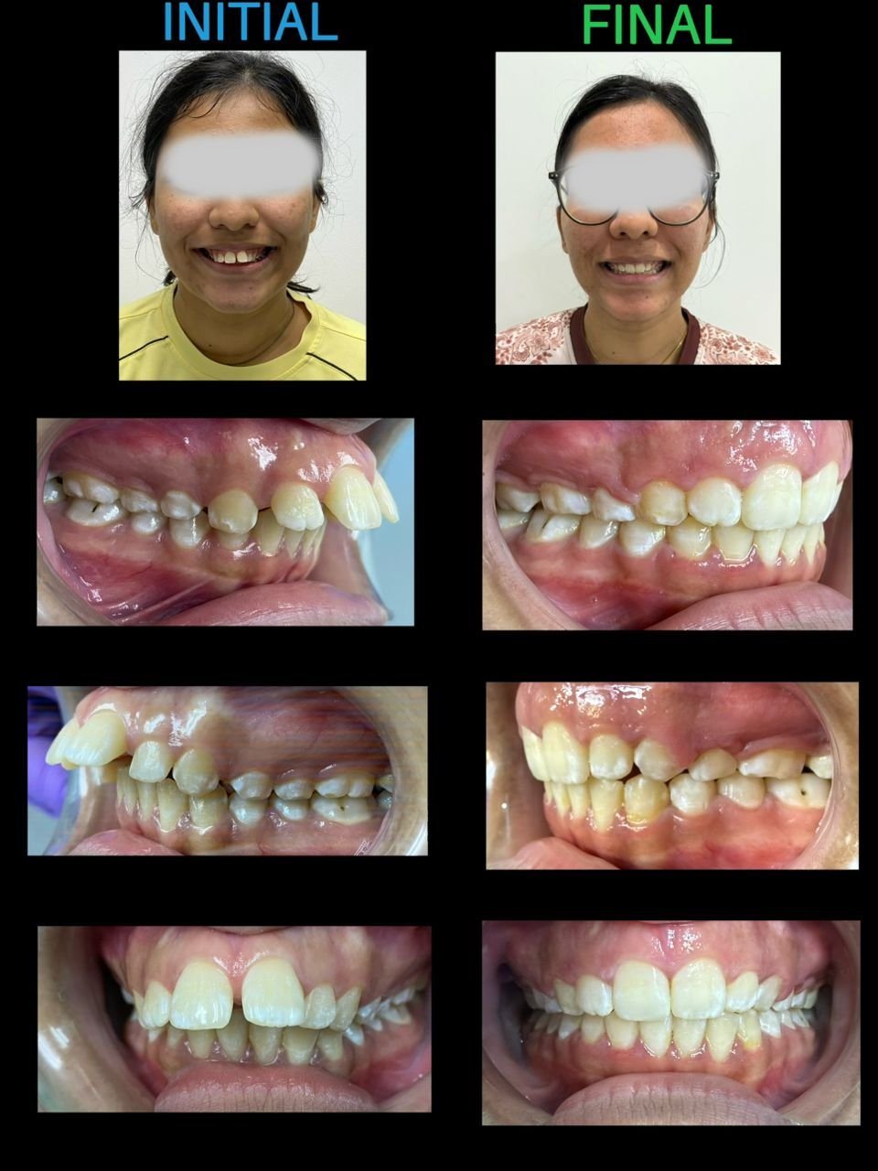 Braces treatment results showing teeth straightening and improved smile at Putramahkota Dental Clinic in Mahkota Cheras