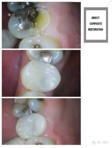 Dental filling restoration procedure at Putramahkota Clinic restoring decayed tooth function and aesthetics in Mahkota Cheras