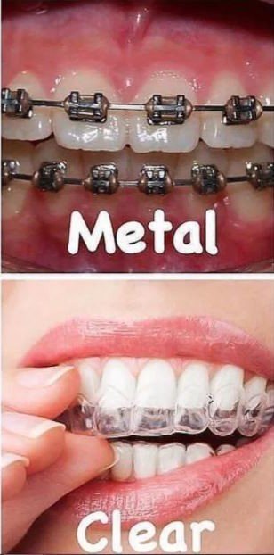 Different types of braces - metal and clear aligners