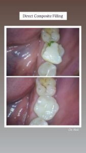 Direct composite filling procedure at Putramahkota Dental Clinic restoring tooth structure with tooth-colored material in Mahkota Cheras