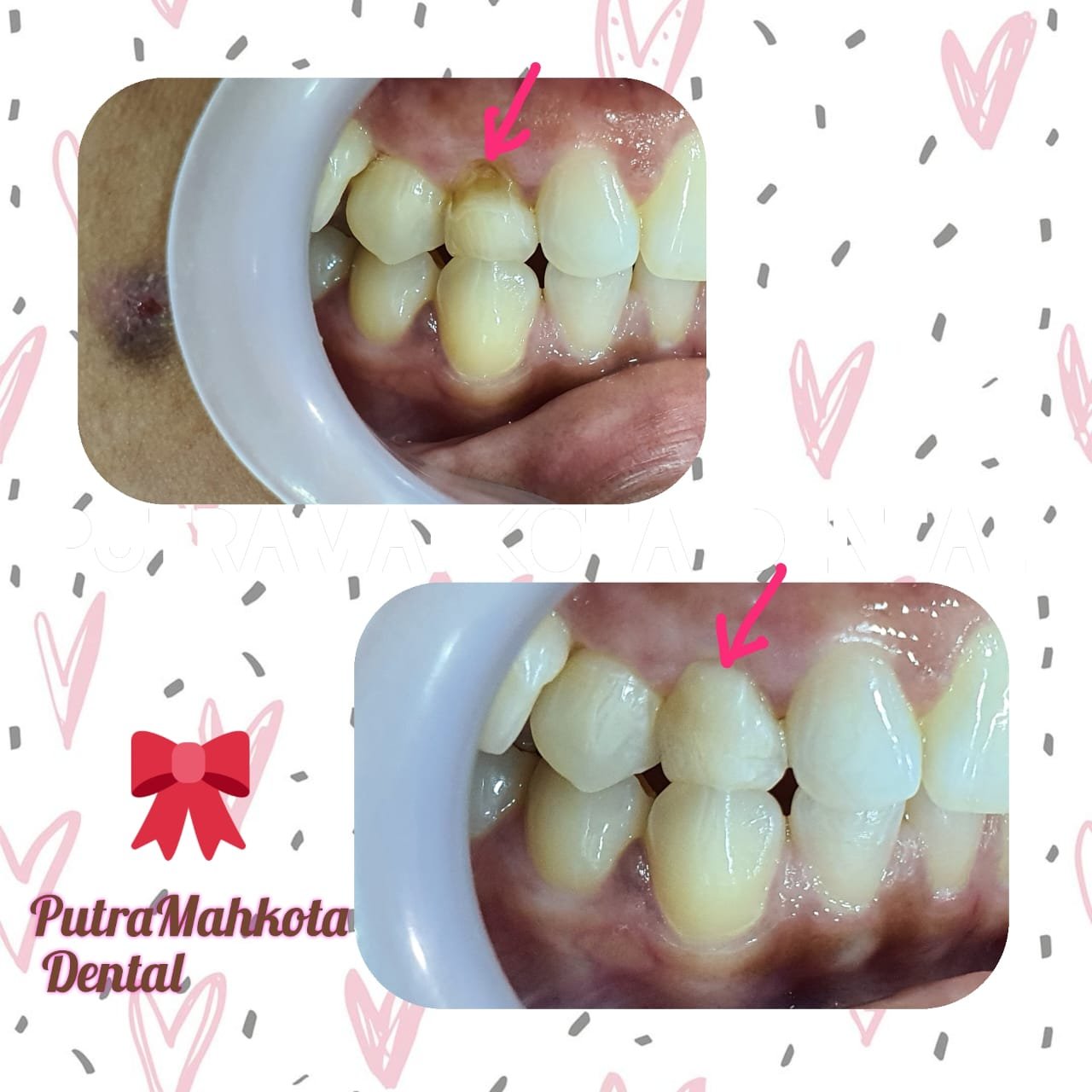 Dental filling treatment for cervical caries at Putramahkota Clinic restoring tooth structure and preventing decay in Mahkota Cheras