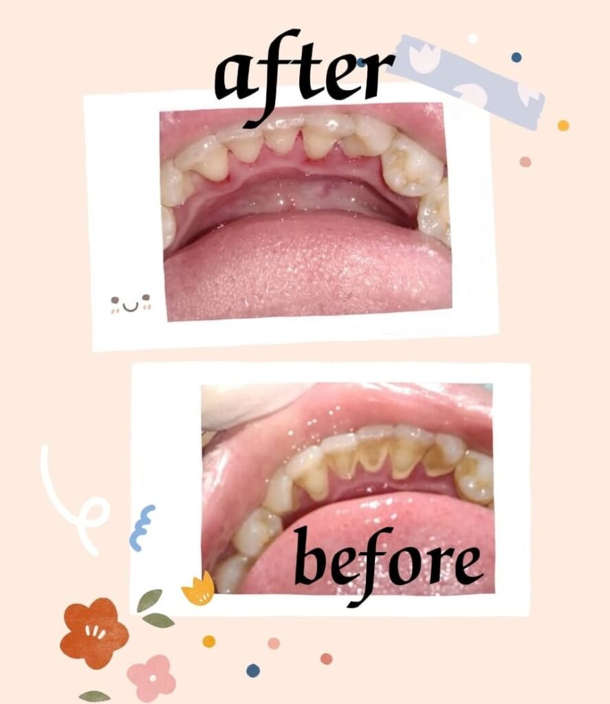 scaling Before and after professional cleaning at Putramahkota Dental Clinic in Mahkota Cheras