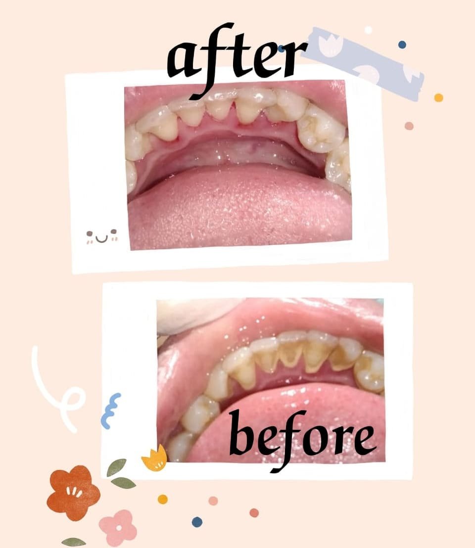 Professional teeth scaling and polishing treatment at Putramahkota Dental Clinic cleaning and brightening teeth in Mahkota Cheras