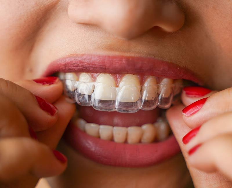 teeth-retainer Custom dental retainer at Putramahkota Dental Clinic in Mahkota Cheras