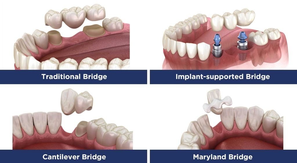 Different types of dental bridges - traditional, cantilever, Maryland, implant-supported