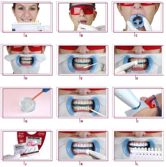 Professional teeth whitening procedure with LED light