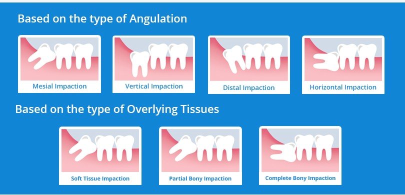 Different types of wisdom tooth impaction shown in X-rays at Putramahkota Dental Clinic