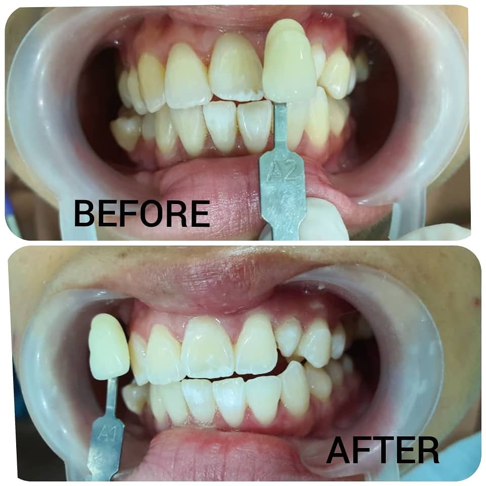 Before and after teeth whitening results at Putramahkota Dental Clinic